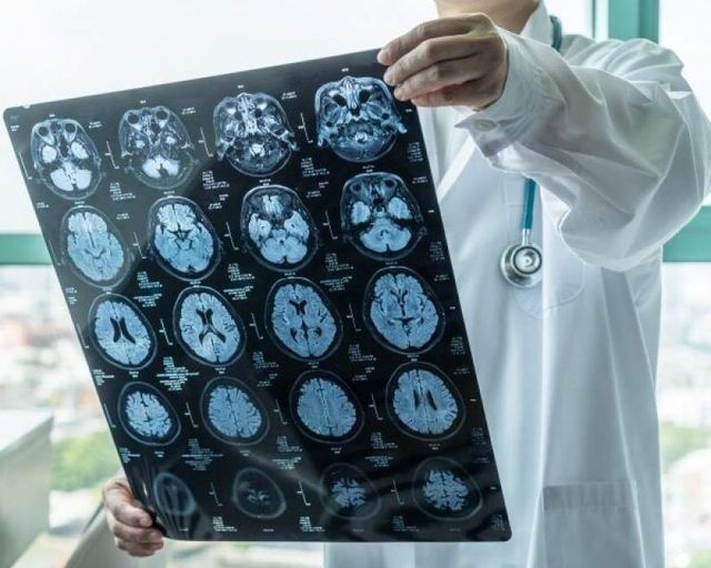 تأیید FDA برای عامل رادیواکتیو Tauklarify در تشخیص آلزایمر